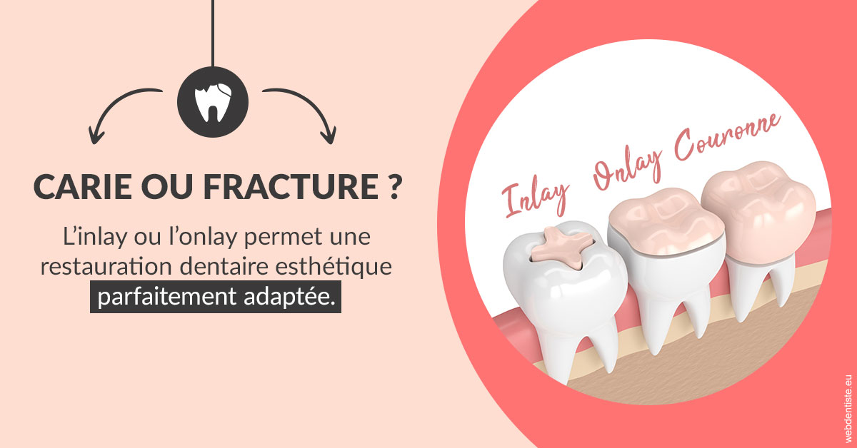 https://www.centredentaireollioules.fr/T2 2023 - Carie ou fracture 2