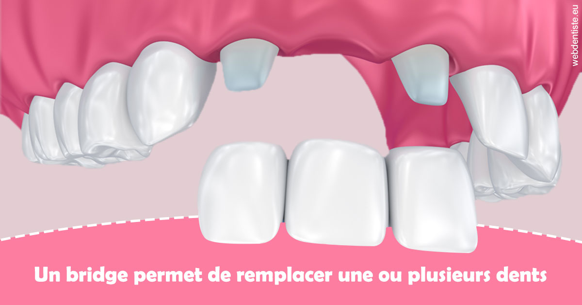 https://www.centredentaireollioules.fr/Bridge remplacer dents 2