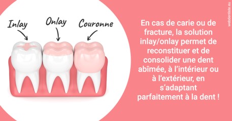 https://www.centredentaireollioules.fr/L'INLAY ou l'ONLAY 2