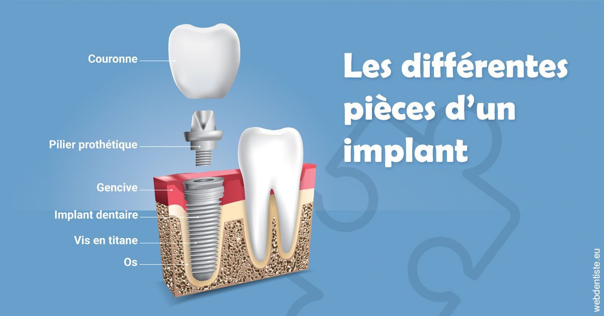 https://www.centredentaireollioules.fr/Les différentes pièces d’un implant 1